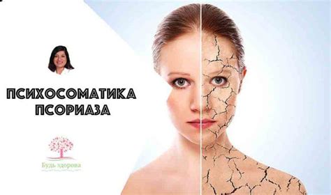 🙁Психосоматика псориаза: есть ли взаимосвязь?🥺