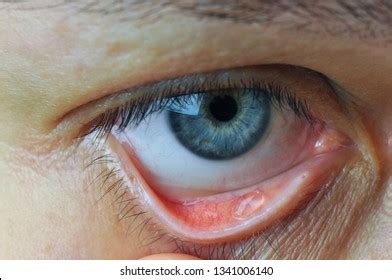 13 Conjunctival Sac Images, Stock Photos & Vectors | Shutterstock