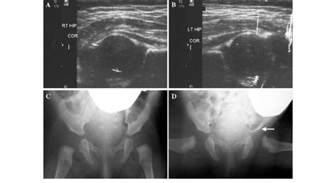 case    born female breech position  normal