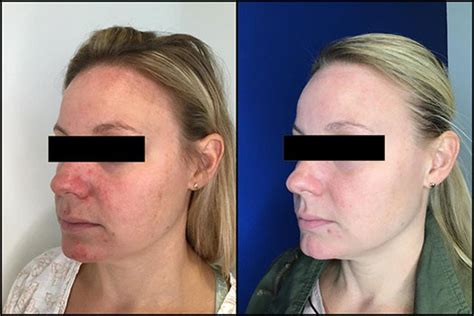 Forever Young BBL - Chesapeake Laser and Skin Care Center