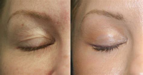 Plexr Plasma Eye Lift Dubai | Non Surgical Blepharoplasty | Non ...