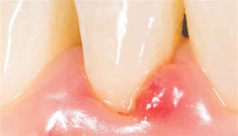 Acute Gingival And Periodontal Conditions Lesions Of - vrogue.co