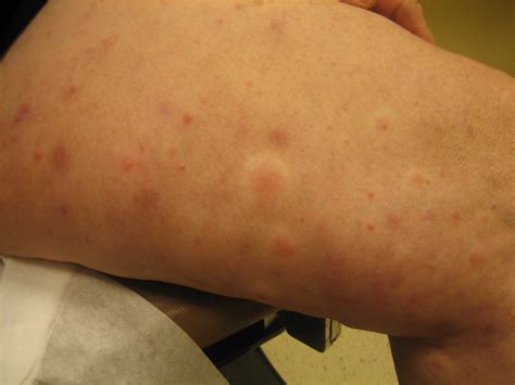 Vasculitis Rash Leukocytoclastic Vasculitis (LCV)