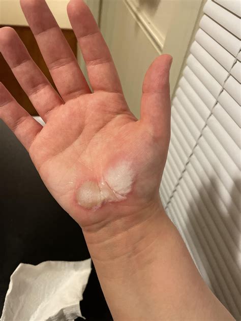 Tripped while running after one of the kids I take care of at work and