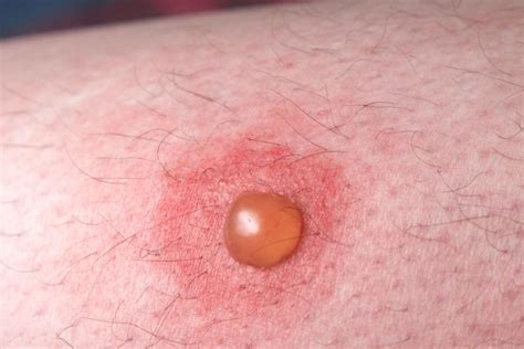 Blisters | nidirect