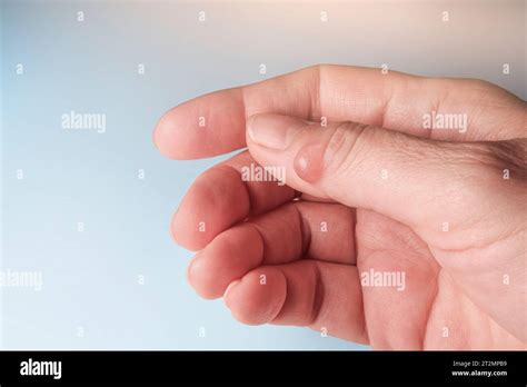 hygroma ganglion cyst   thumb joint selective focus stock photo