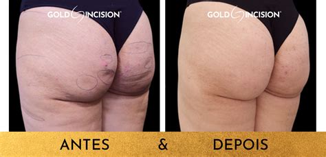 Subcisão Para Celulite Antes E Depois - Tratamento da Celulite com Subincisão e Preenchimento