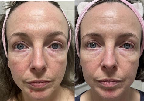 azelaic acid