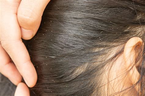 head lice pictures    lice bite