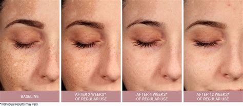 Hyperpigmentation Treatment & Skincare | Eucerin UK