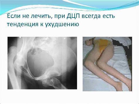 Вывихи бедра при ДЦП Михаэль Фишкин Шломо Хайк