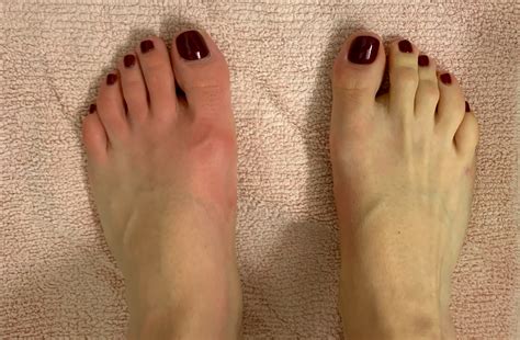 IVIG for autoimmune small-fiber neuropathy ~ My Autoimmune Small-Fiber