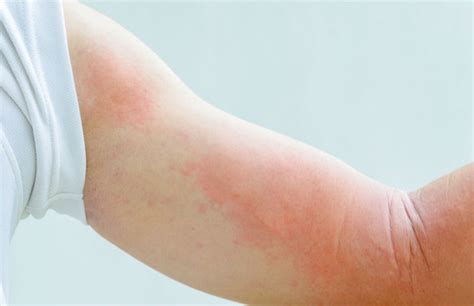 Что такое нейродермит? | Kosmetologiya-dermatologiya.az