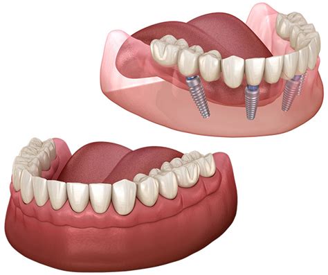 Full Mouth Dental Implants