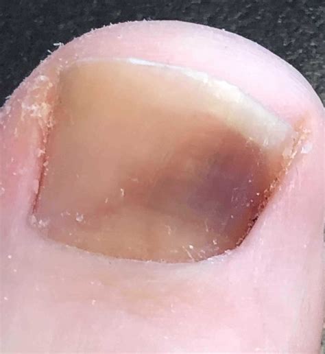 Big Toenail Subungual Hematoma: Images Show Healing Over Time » Scary