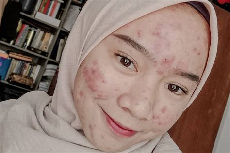 foto orang berjerawat