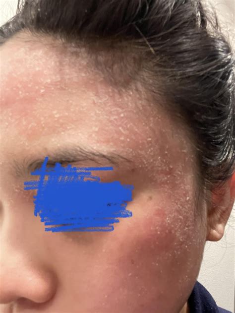 personal experience  seb derm rsebderm