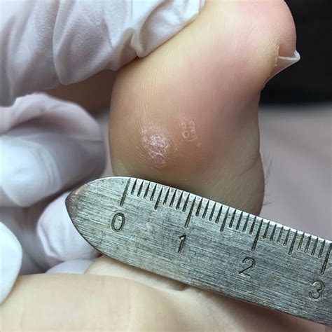 verruca treatment options care  feet