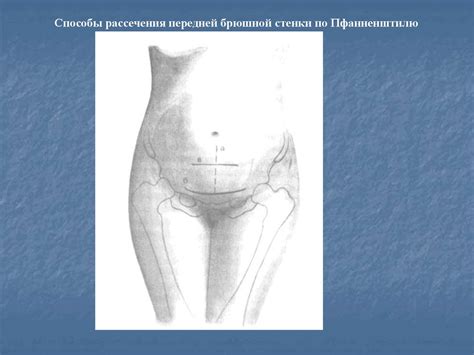 Показания к плановому кесареву сечению во время беременности ...
