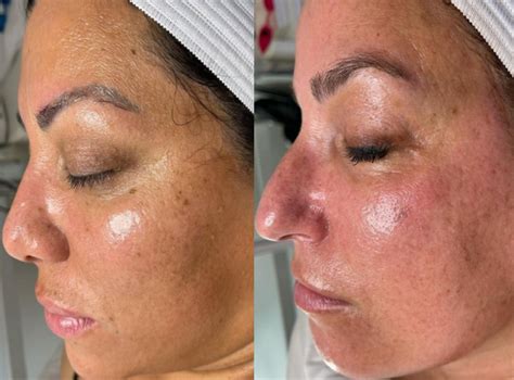 Hydrafacial Neck Before And After at Jordan Mealmaker blog