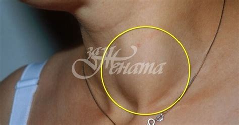 Очевидните симптоми за рак на щитовидната жлеза, които трябва да ни ...