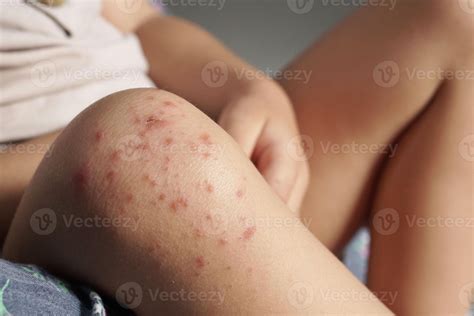 Close up view of Child's knee infected with hand feet and mouth disease