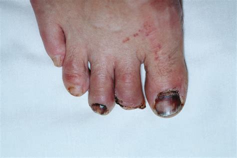 amputated toe photograph  science photo library pixels