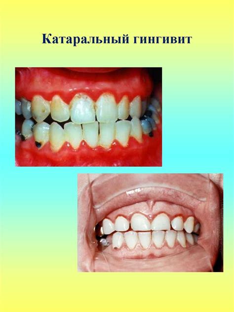 Гингивиты. Классификация гингивитов - презентация онлайн