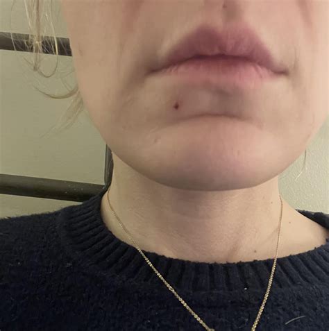 How can I treat this post pimple scab? : r/SkincareAddicts