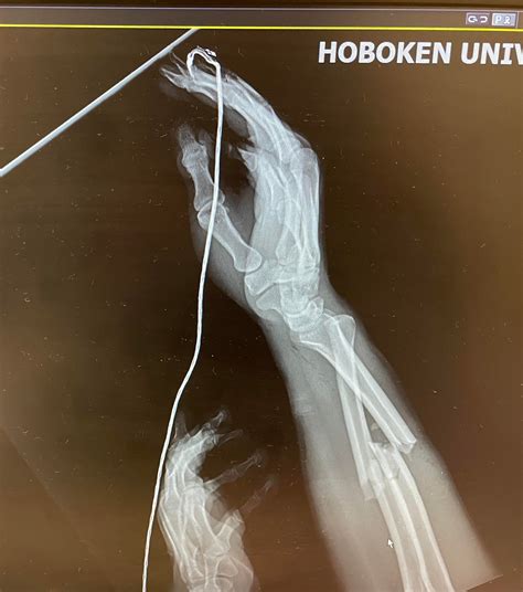 Fell and broke my arm from slick road on Observer Highway in Hoboken