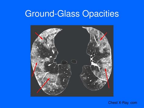chest radiology plain film  ct   basics powerpoint