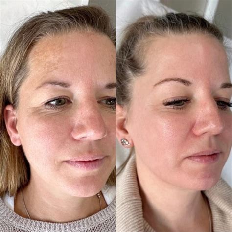 sculptra  top choice   surgical cheek lift hush la medspa