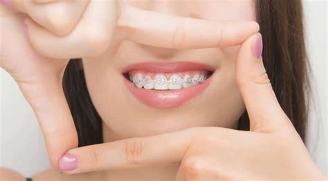behel keramik  gigi alignment  bogor solusi tepat
