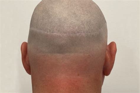 scar reduction head brisbane skin dermatologist brisbane medical