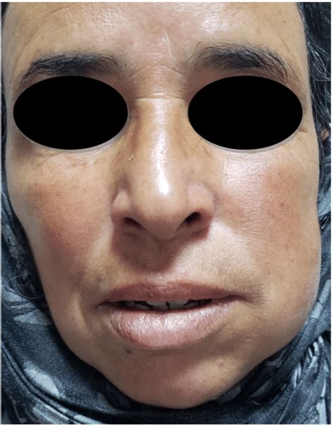 preoperative external   left cheek swelling