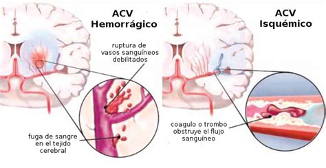 29 de Octubre - Día Mundial del Accidente Cerebro Vascular - Instituto ...