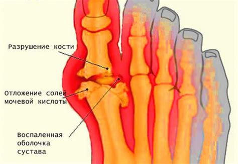 Подагра: причины, симптомы и лечение - Estet-Portal