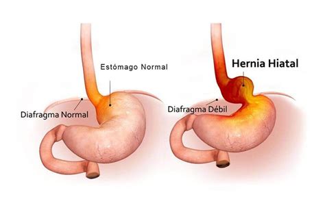 Hernia No Estomago O Que Causa - Hernia de Hiato: Síntomas, diagnóstico y tratamiento en Sevilla