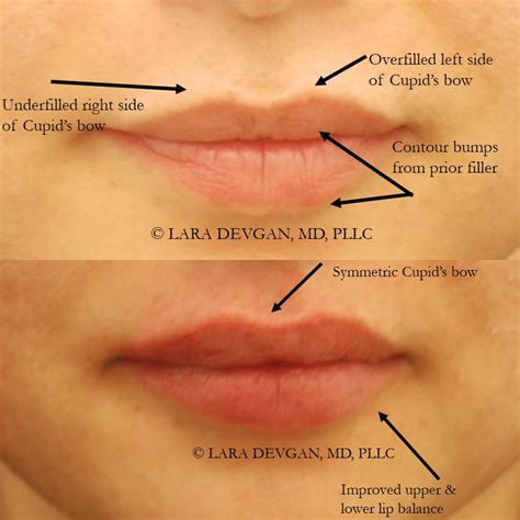 How To Remove Lip Filler Lumps at Grace Brentnall blog