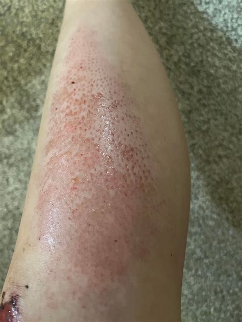 Why does my skin have these holes on it after I crashed on my longboard