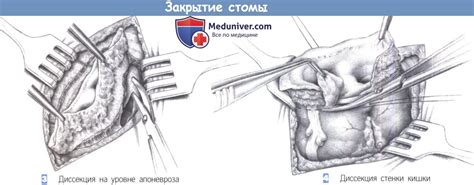 Показания, этапы и техника закрытия стомы