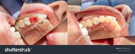 57 Tooth Extraction Before After Images, Stock Photos & Vectors ...