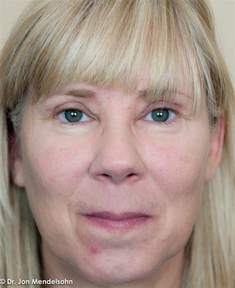 Eyelid Services – Advanced Cosmetic Surgery & Laser Center