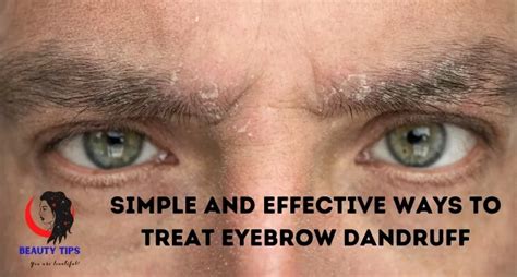 Eyebrow Dandruff – Symptoms, Causes, Treatments & Prevention