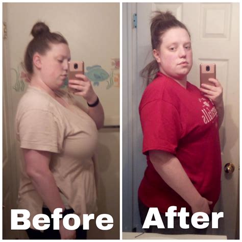 My Breast Reduction