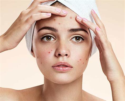 Have Acne Prone Skin? Here Are Some Things You Should Avoid Doing ...