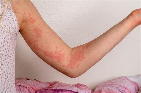 hives urticaria