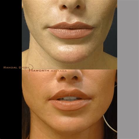 HS before and After | Dr. Haworth