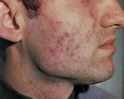 Туберкулез кожи, симптомы и лечение, признаки и фото