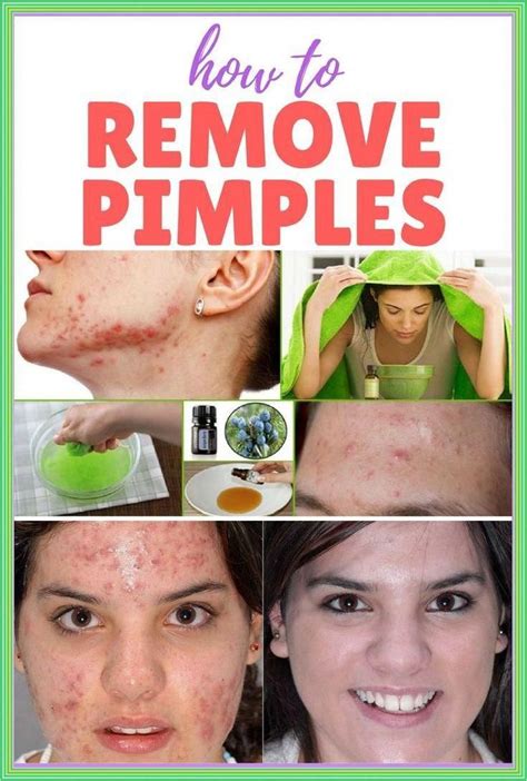 how to easily get rid of pimples overnight